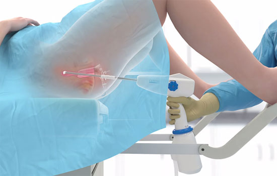 Cryo Procedure