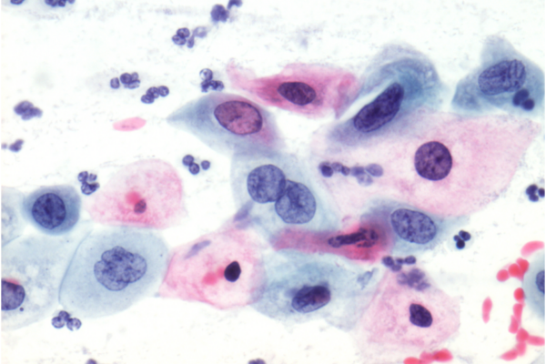 Dyskaryosis – Abnormal Smear Test & Treatment
