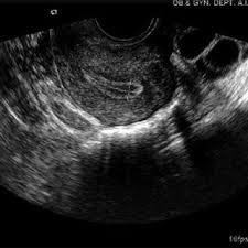 EndomeTRIO — Triple Endometrial Analysis