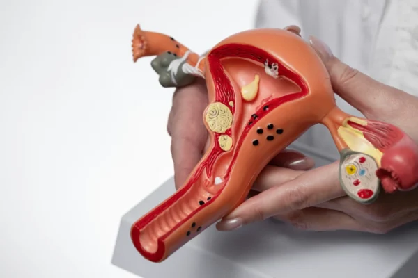 Endometriosis Treatment