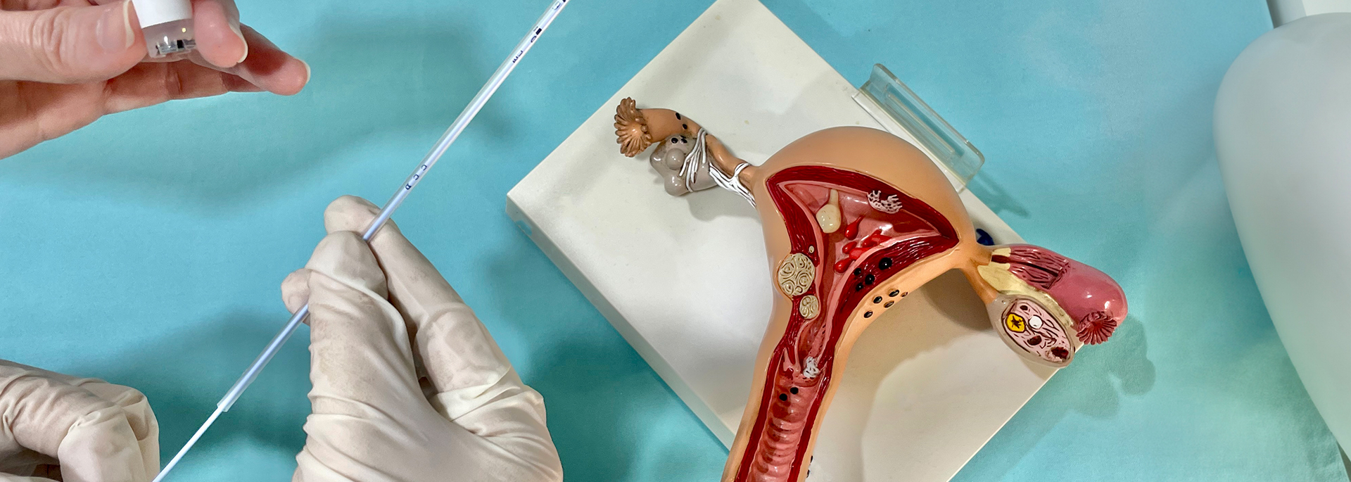ERA — Endometrial Receptivity Analysis