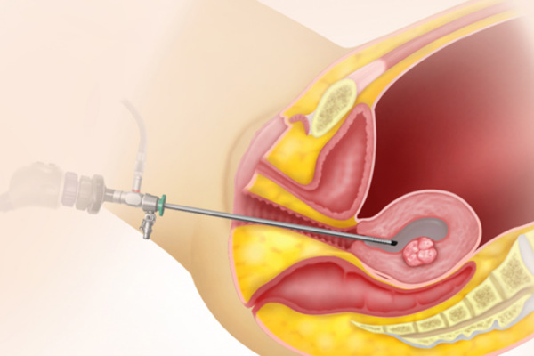 ERPC – Evacuation of Retained Products of Conception