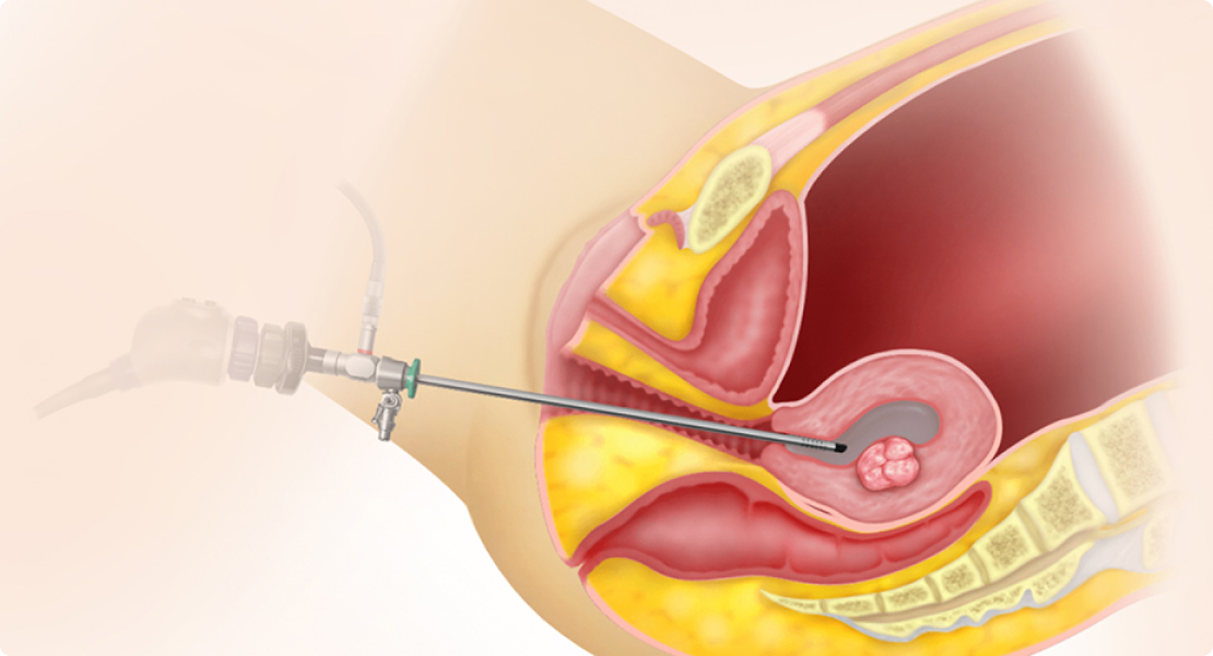 ERPC - Evacuation of Retained Products of Conception