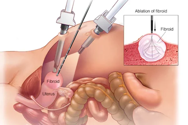 Fibroids Diagnosis and Treatment