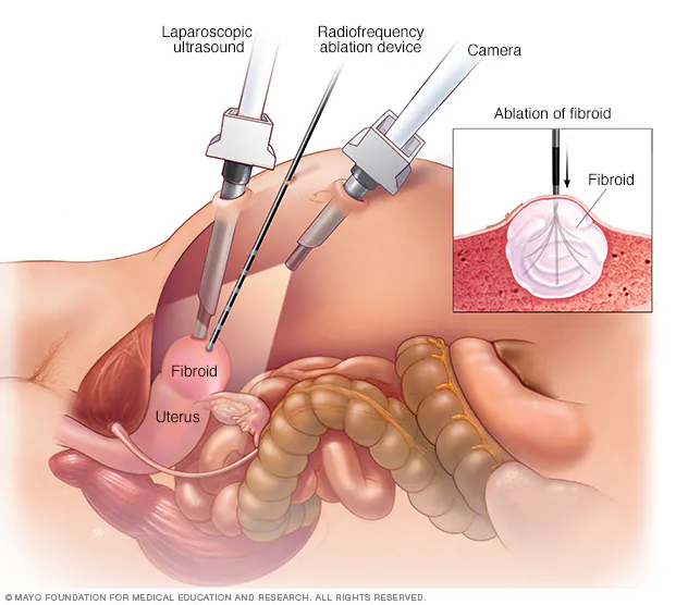 Fibroids Diagnosis and Treatment