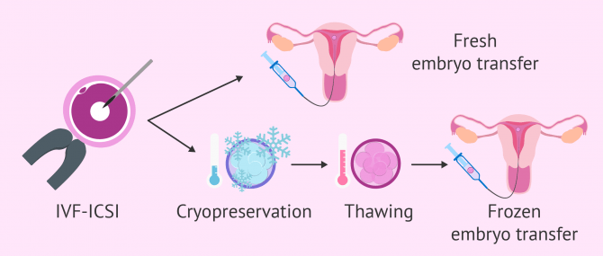 Frozen Embryo Transfer (FET)