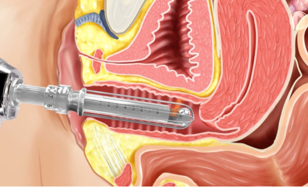 Laser Vaginal Rejuvenation