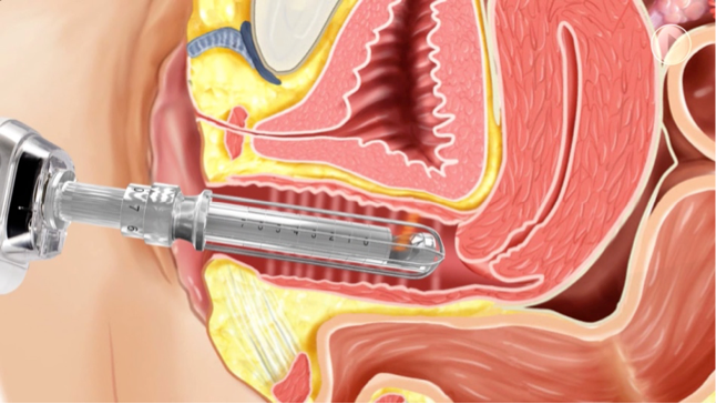 Laser Vaginal Rejuvenation