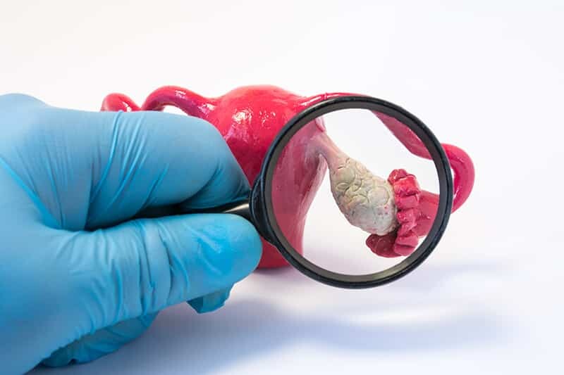 Ovarian Cysts Removal Surgery & Recovery