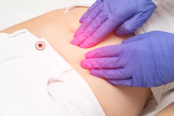 Fachärztliche Behandlung des PCOS (Polyzystisches Ovarialsyndrom)