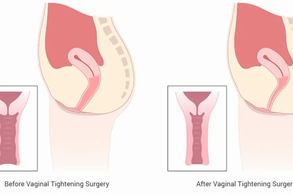 Vagina Tightening Surgery
