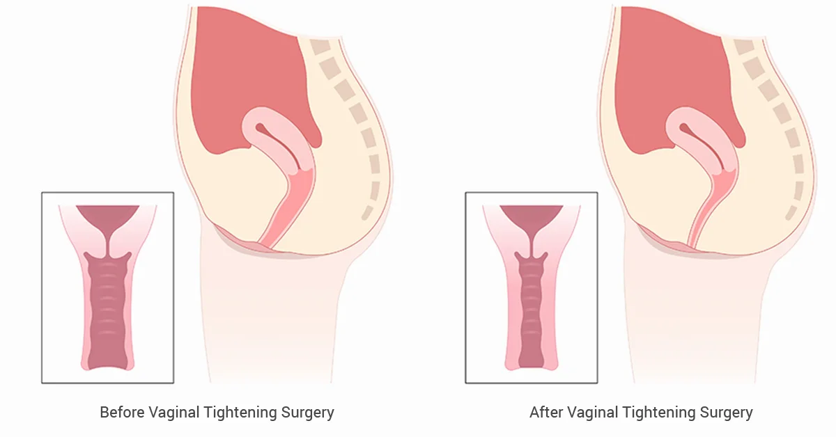 Vagina Tightening Surgery